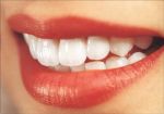 implante dentário seleção