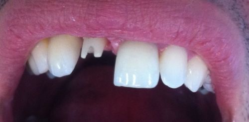 Implante Dentario Carga Imediata 484114