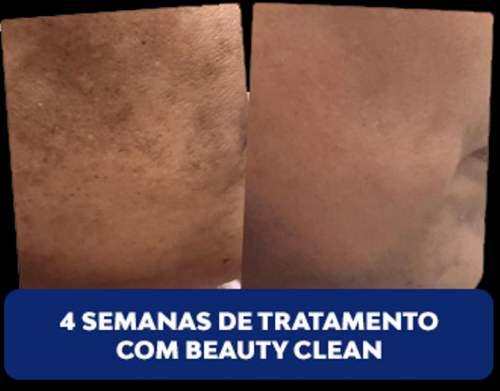 Beauty Clean - Tratamento Para Melasmas 622905