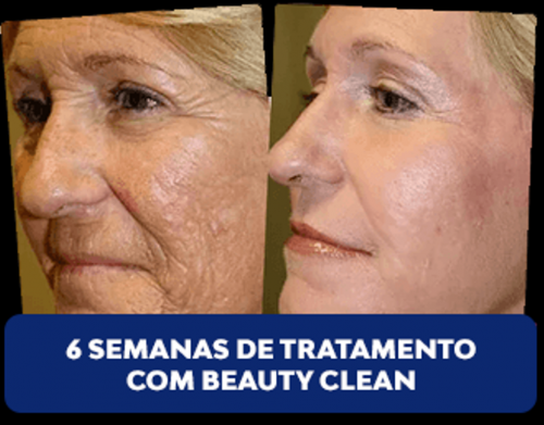 Beauty Clean - Tratamento Para Melasmas 622906