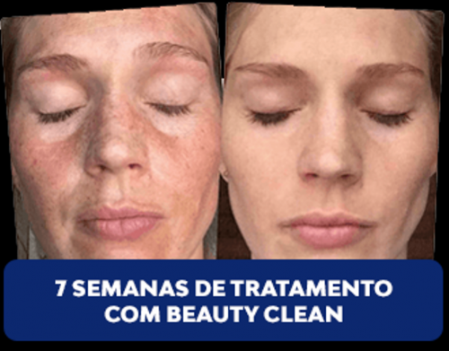 Beauty Clean - Tratamento Para Melasmas 622907