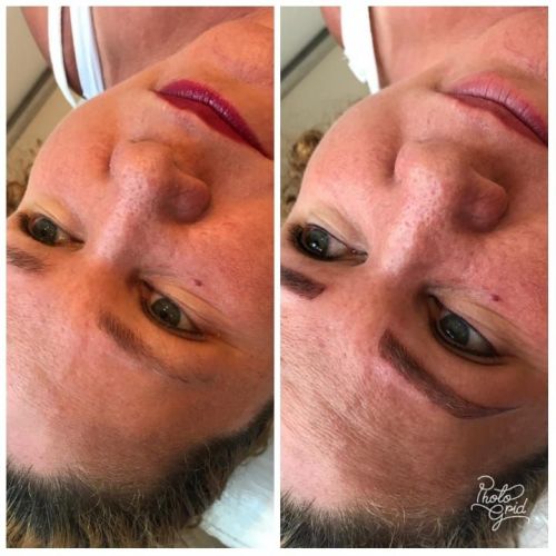 Botox  Micropigmentação 742092