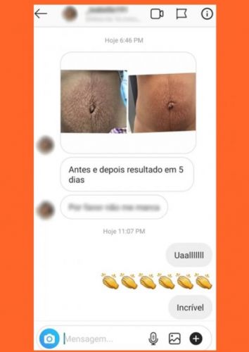  Pele suave Firme Sem Flacidez e Sem Estrias é o que você Deseja? 703058