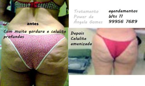 Drenagem linfática para gestantes pós cirurgia pessoas com inchaço nas pernas 781450
