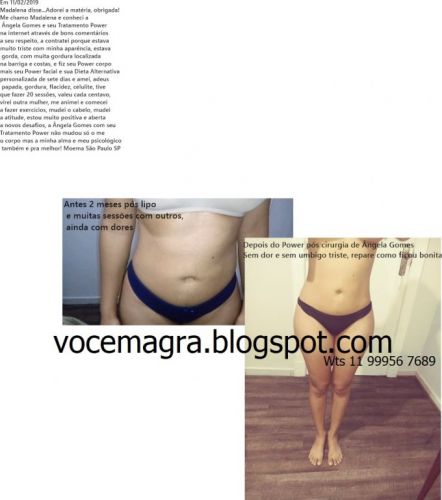 Drenagem linfática para gestantes pós cirurgia pessoas com inchaço nas pernas 781451