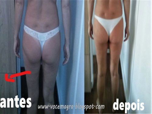 Drenagem linfática para gestantes pós cirurgia pessoas com inchaço nas pernas 781452