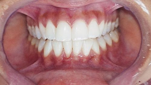 implante dentario 706367