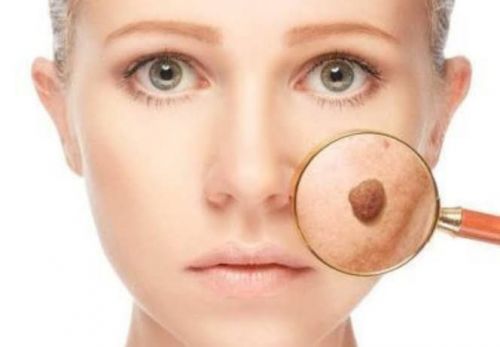 Remoção a laser de pintas e verrugas  746721