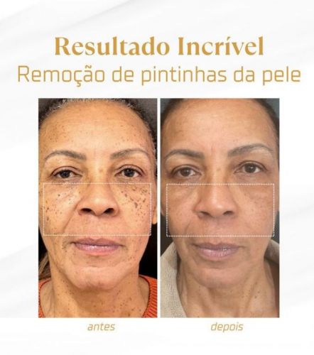 Remoção a laser de pintas e verrugas  753968