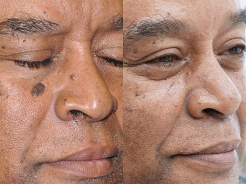 Remoção a laser de pintas e verrugas  766864