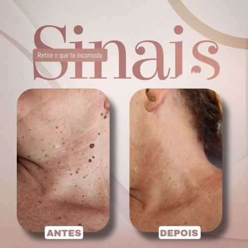 Remoção a laser de pintas e verrugas com resultado imediato  777055
