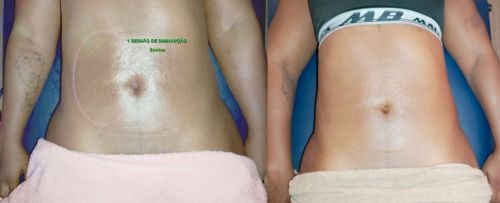 Sessão De Massagem Relaxante Terapêutica Por Apenas R$129 Na Freguesia Do Ó 761116